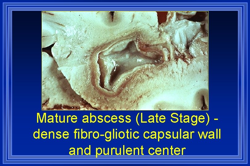 Mature abscess (Late Stage) dense fibro-gliotic capsular wall and purulent center 