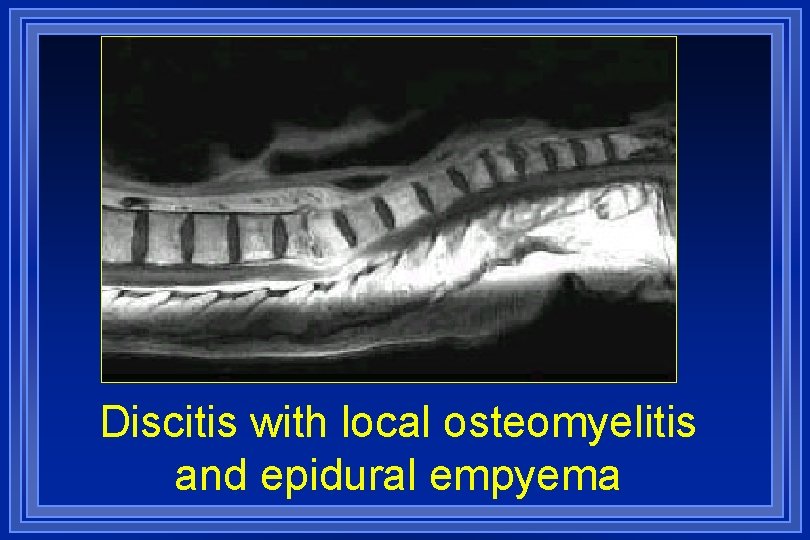 Discitis with local osteomyelitis and epidural empyema 