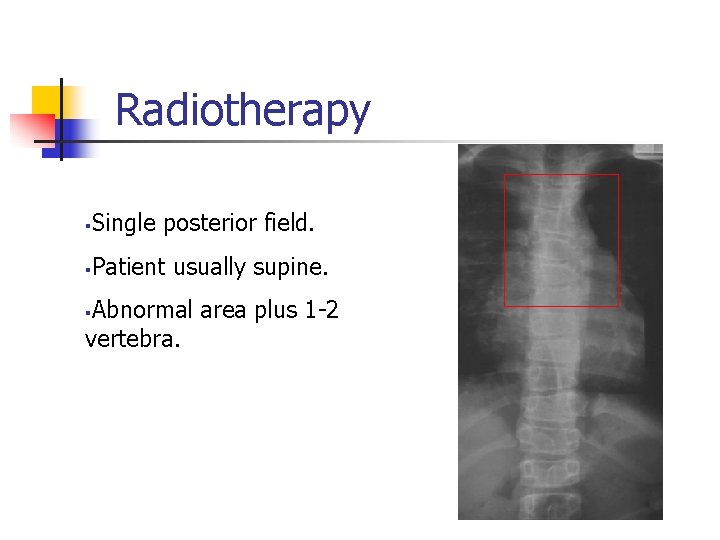 Radiotherapy § Single posterior field. § Patient usually supine. Abnormal area plus 1 -2 Radiotherapy § Single posterior field. § Patient usually supine. Abnormal area plus 1 -2