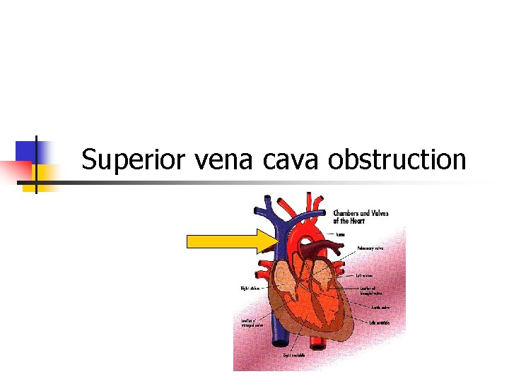 Superior vena cava obstruction Superior vena cava obstruction
