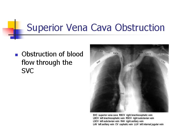 Superior Vena Cava Obstruction n Obstruction of blood flow through the SVC Superior Vena Cava Obstruction n Obstruction of blood flow through the SVC