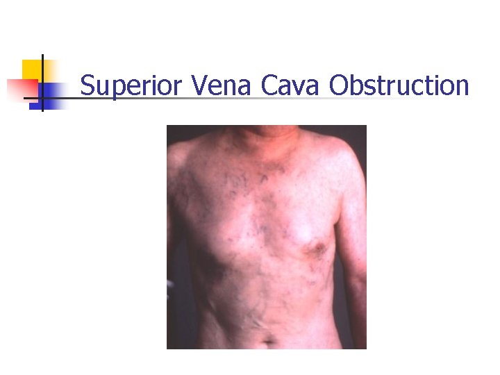 Superior Vena Cava Obstruction Superior Vena Cava Obstruction