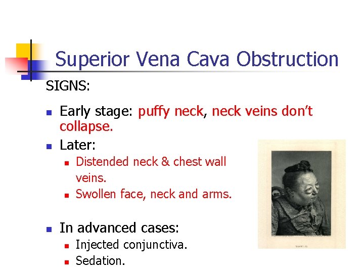 Superior Vena Cava Obstruction SIGNS: n n Early stage: puffy neck, neck veins don’t Superior Vena Cava Obstruction SIGNS: n n Early stage: puffy neck, neck veins don’t