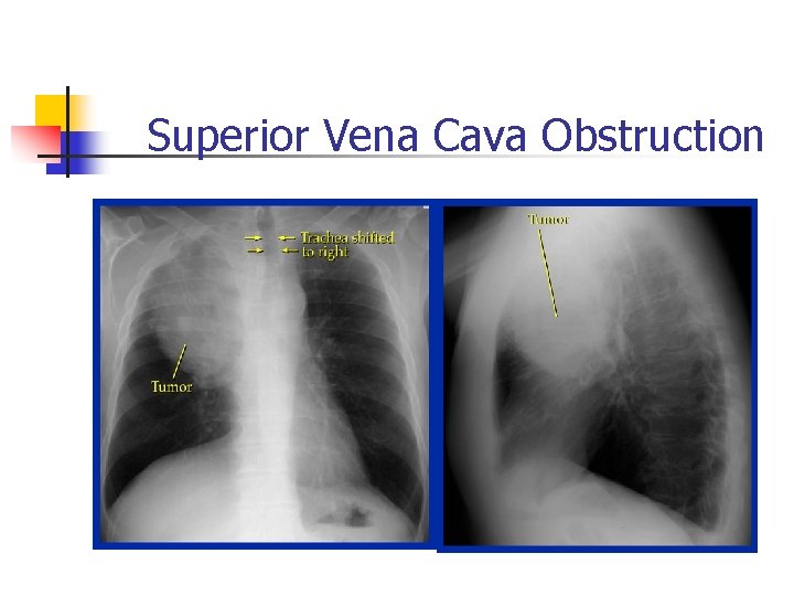Superior Vena Cava Obstruction Superior Vena Cava Obstruction