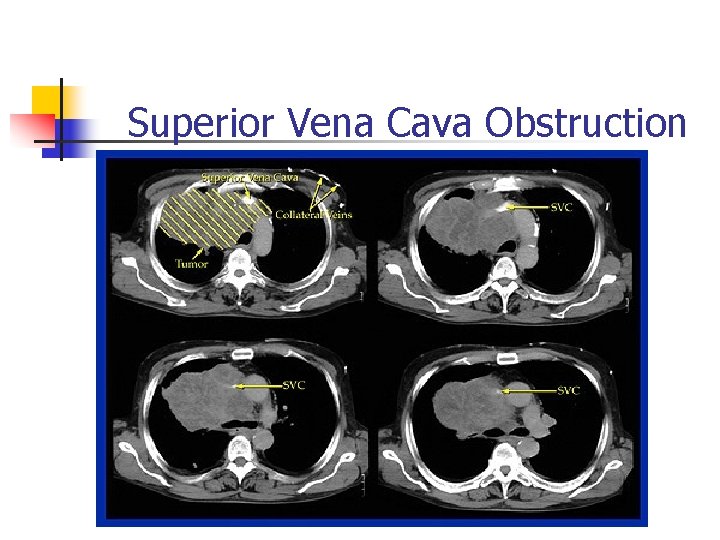 Superior Vena Cava Obstruction Superior Vena Cava Obstruction