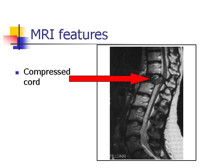 MRI features n Compressed cord MRI features n Compressed cord