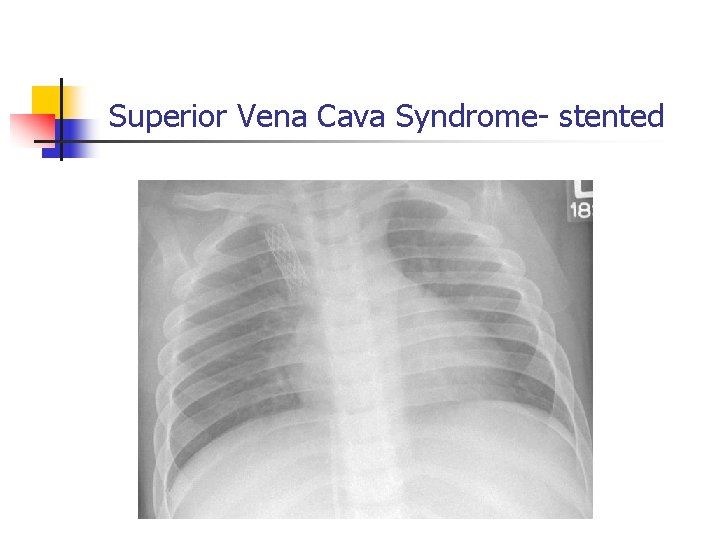 Superior Vena Cava Syndrome- stented Superior Vena Cava Syndrome- stented