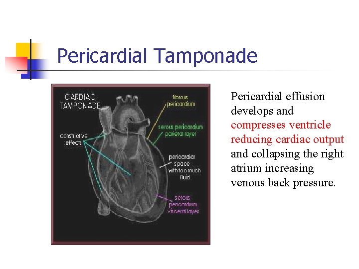 Pericardial Tamponade Pericardial effusion develops and compresses ventricle reducing cardiac output and collapsing the Pericardial Tamponade Pericardial effusion develops and compresses ventricle reducing cardiac output and collapsing the