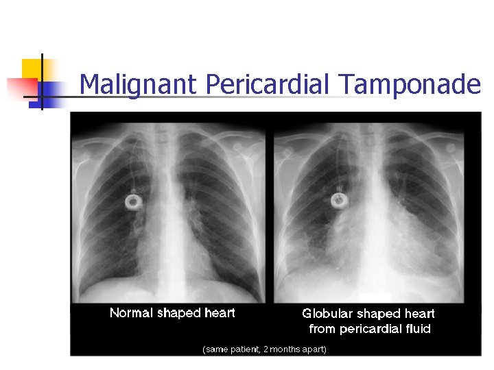 Malignant Pericardial Tamponade Malignant Pericardial Tamponade