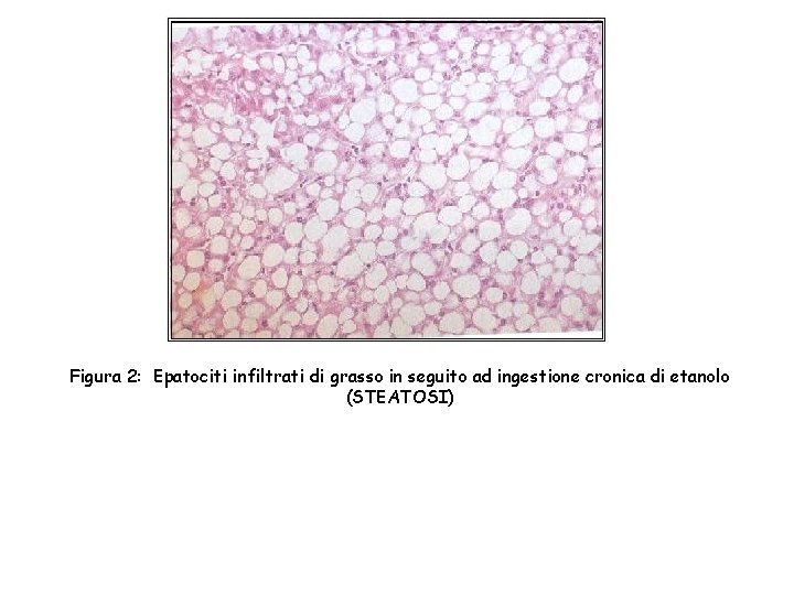 Figura 2: Epatociti infiltrati di grasso in seguito ad ingestione cronica di etanolo (STEATOSI)