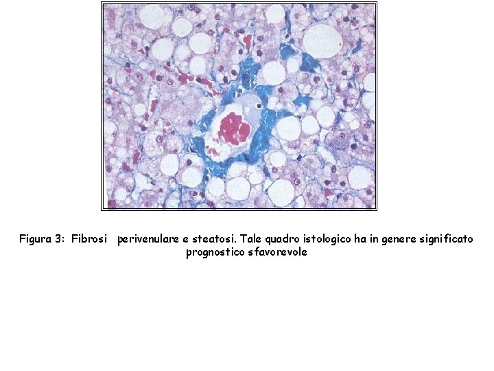 Figura 3: Fibrosi perivenulare e steatosi. Tale quadro istologico ha in genere significato prognostico