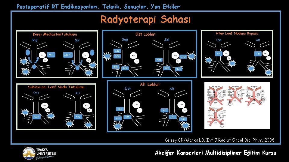 Postoperatif RT Endikasyonları, Teknik, Sonuçlar, Yan Etkiler Radyoterapi Sahası Kelsey CR/Marks LB. Int J