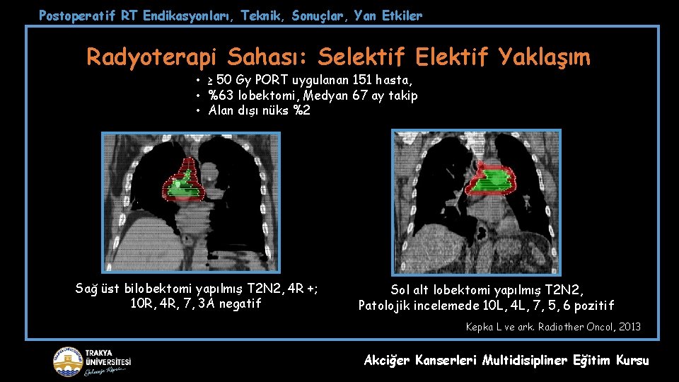 Postoperatif RT Endikasyonları, Teknik, Sonuçlar, Yan Etkiler Radyoterapi Sahası: Selektif Elektif Yaklaşım • ≥