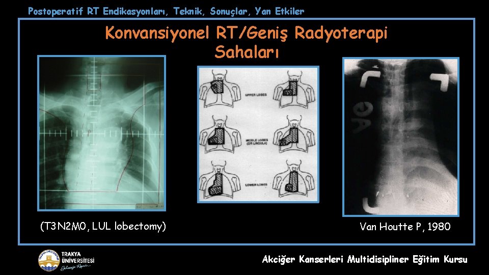 Postoperatif RT Endikasyonları, Teknik, Sonuçlar, Yan Etkiler Konvansiyonel RT/Geniş Radyoterapi Sahaları (T 3 N