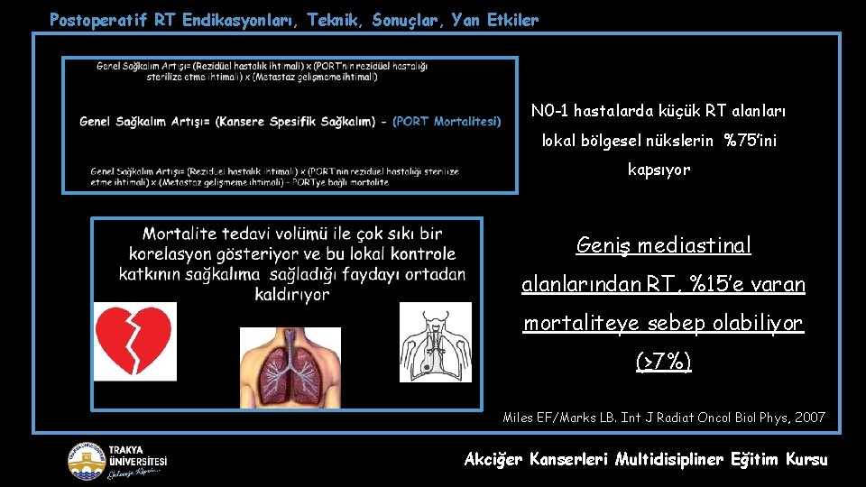 Postoperatif RT Endikasyonları, Teknik, Sonuçlar, Yan Etkiler N 0 -1 hastalarda küçük RT alanları