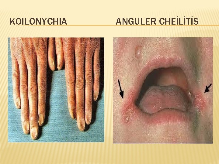 KOILONYCHIA ANGULER CHEİLİTİS 
