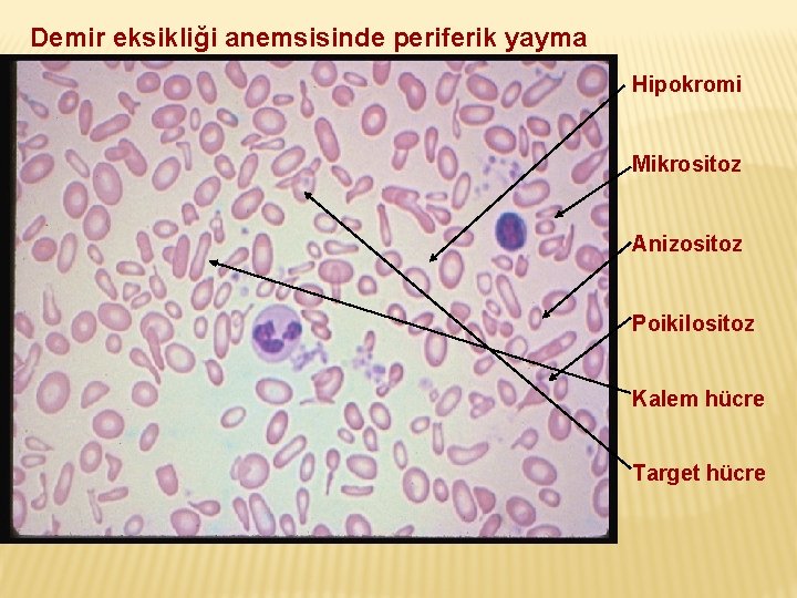 Demir eksikliği anemsisinde periferik yayma Hipokromi Mikrositoz Anizositoz Poikilositoz Kalem hücre Target hücre 