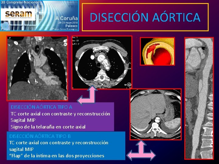 DISECCIÓN AÓRTICA © © DISECCIÓN AÓRTICA TIPO A TC corte axial contraste y reconstrucción