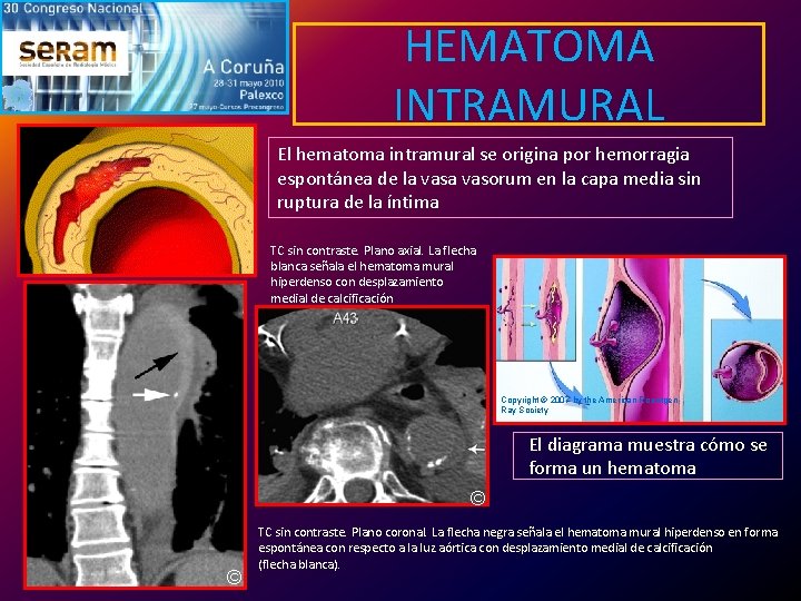 HEMATOMA INTRAMURAL El hematoma intramural se origina por hemorragia espontánea de la vasorum en