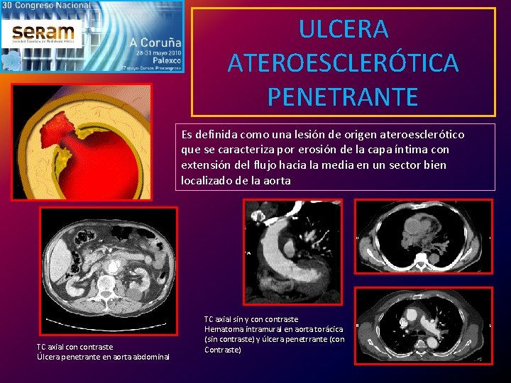 ULCERA ATEROESCLERÓTICA PENETRANTE Es definida como una lesión de origen ateroesclerótico que se caracteriza