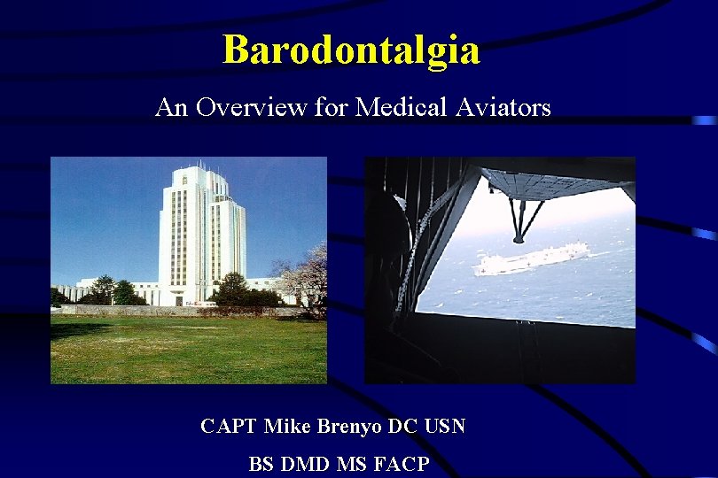 Barodontalgia An Overview for Medical Aviators CAPT Mike Brenyo DC USN BS DMD MS