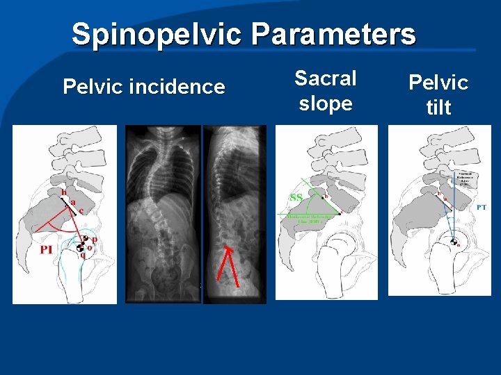 Spinopelvic Parameters Pelvic incidence Sacral slope Pelvic tilt 