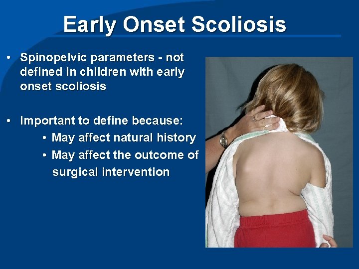 Early Onset Scoliosis • Spinopelvic parameters - not defined in children with early onset