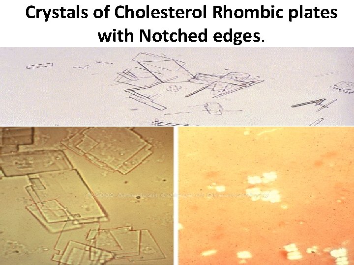 Crystals of Cholesterol Rhombic plates with Notched edges. 