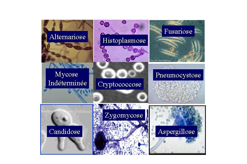 Alternariose Mycose Indéterminée Fusariose Histoplasmose Pneumocystose Cryptococcose Zygomycose Candidose Aspergillose 