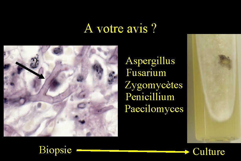 A votre avis ? Aspergillus Fusarium Zygomycètes Penicillium Paecilomyces ? Biopsie Culture 