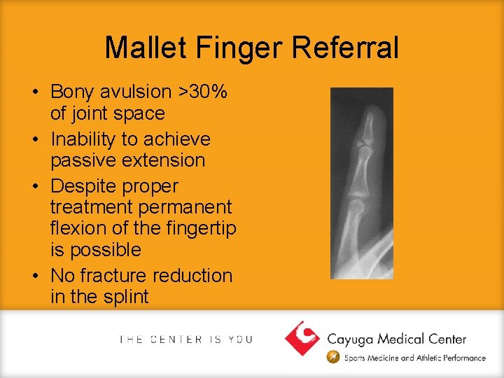 Mallet Finger Referral • Bony avulsion >30% of joint space • Inability to achieve