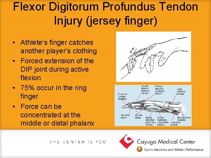 Flexor Digitorum Profundus Tendon Injury (jersey finger) • Athlete’s finger catches another player’s clothing