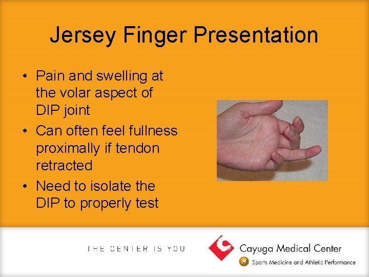Jersey Finger Presentation • Pain and swelling at the volar aspect of DIP joint
