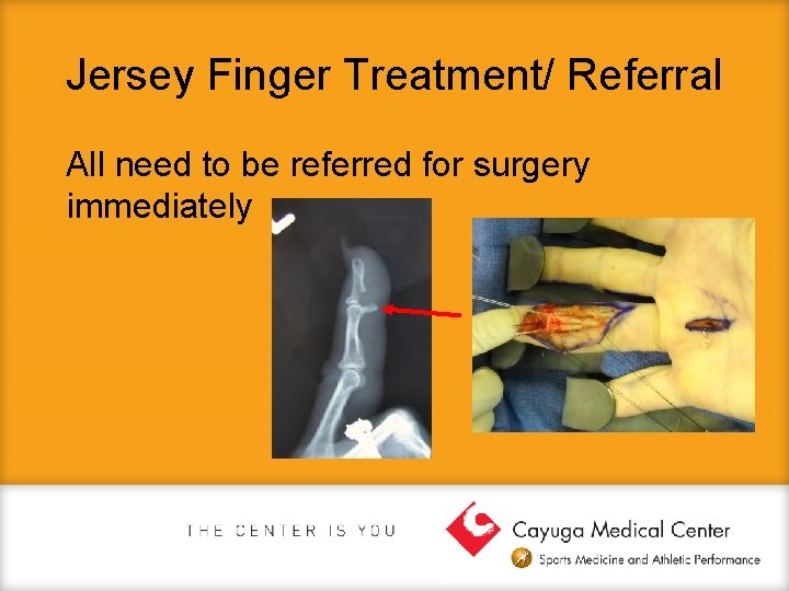 Jersey Finger Treatment/ Referral All need to be referred for surgery immediately 