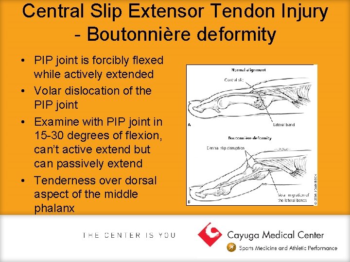 Central Slip Extensor Tendon Injury - Boutonnière deformity • PIP joint is forcibly flexed