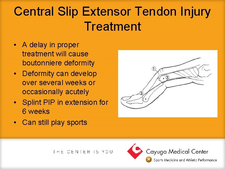 Central Slip Extensor Tendon Injury Treatment • A delay in proper treatment will cause