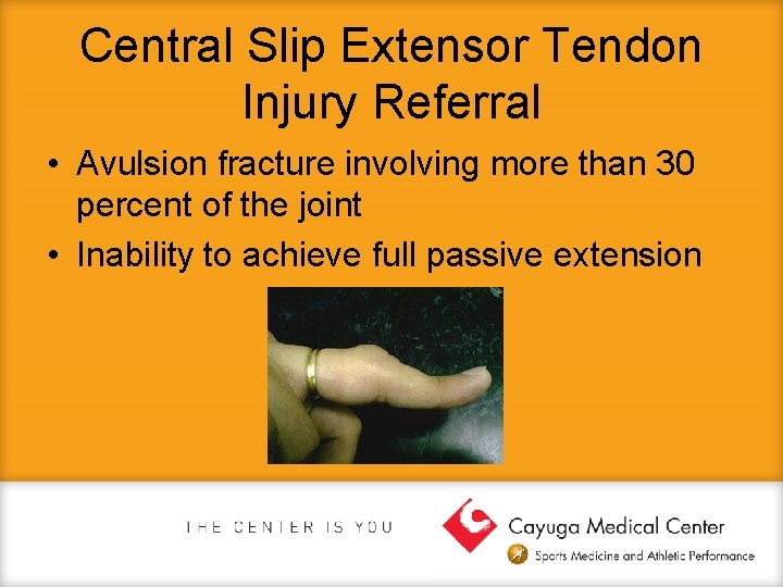 Central Slip Extensor Tendon Injury Referral • Avulsion fracture involving more than 30 percent