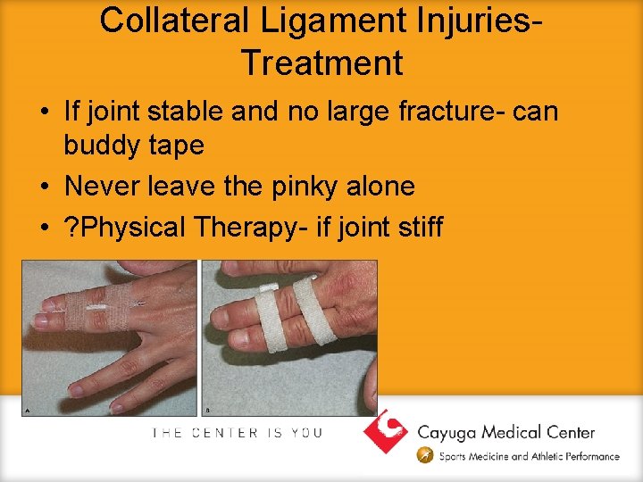 Collateral Ligament Injuries. Treatment • If joint stable and no large fracture- can buddy