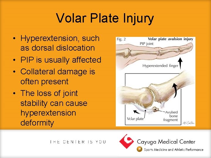 Volar Plate Injury • Hyperextension, such as dorsal dislocation • PIP is usually affected