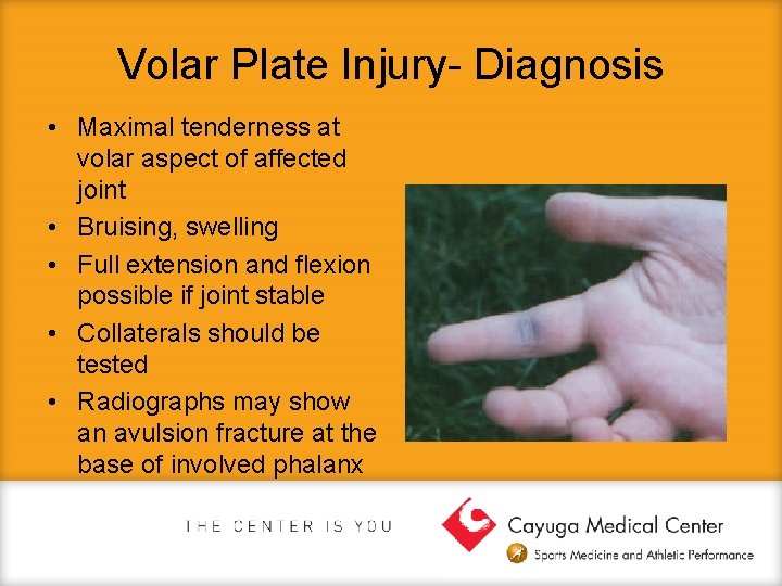 Volar Plate Injury- Diagnosis • Maximal tenderness at volar aspect of affected joint •