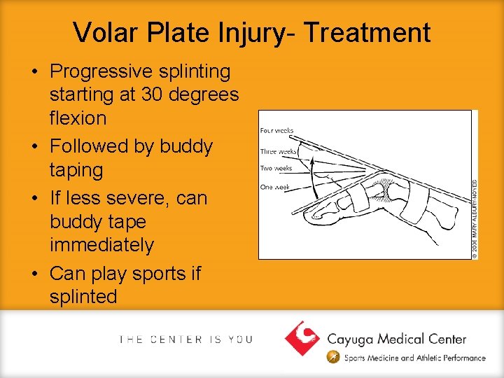 Volar Plate Injury- Treatment • Progressive splinting starting at 30 degrees flexion • Followed