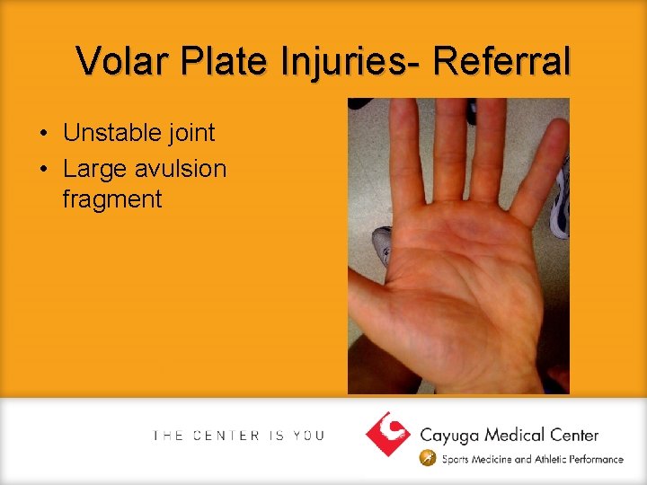 Volar Plate Injuries- Referral • Unstable joint • Large avulsion fragment 