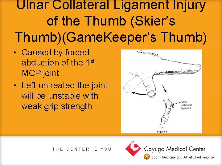 Ulnar Collateral Ligament Injury of the Thumb (Skier’s Thumb)(Game. Keeper’s Thumb) • Caused by