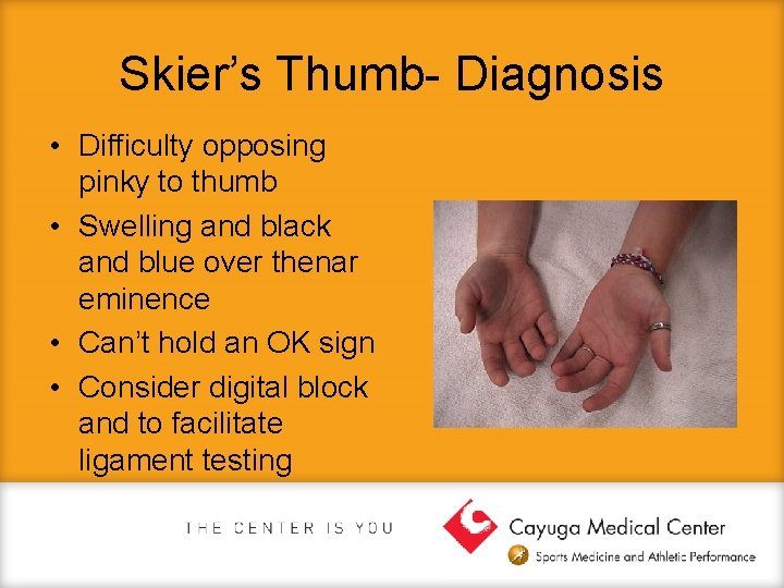 Skier’s Thumb- Diagnosis • Difficulty opposing pinky to thumb • Swelling and black and