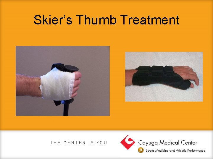 Skier’s Thumb Treatment 