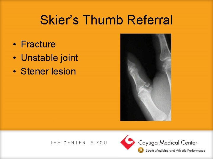 Skier’s Thumb Referral • Fracture • Unstable joint • Stener lesion 