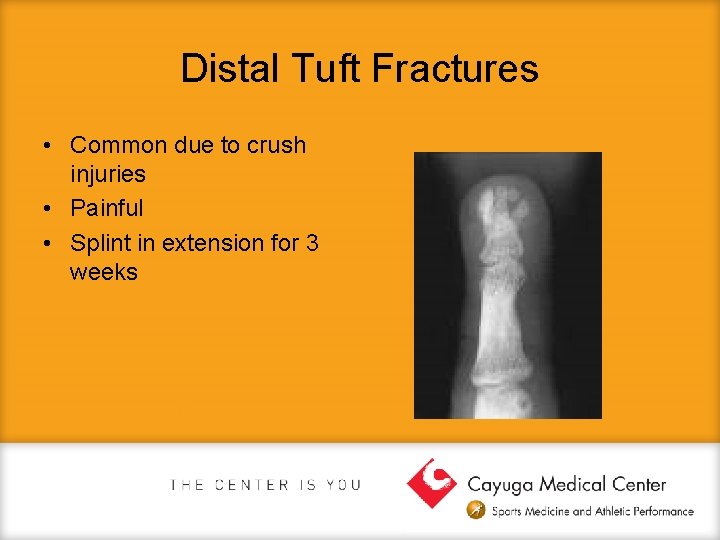 Distal Tuft Fractures • Common due to crush injuries • Painful • Splint in