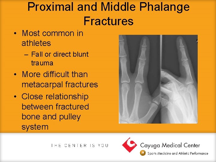 Proximal and Middle Phalange Fractures • Most common in athletes – Fall or direct