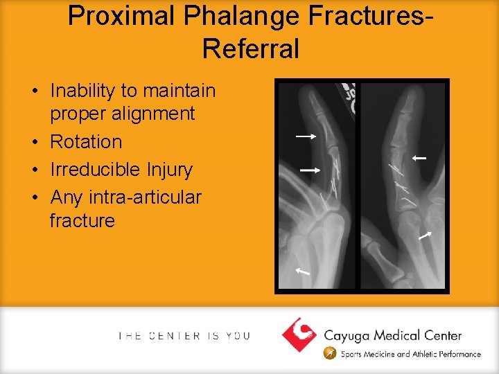 Proximal Phalange Fractures. Referral • Inability to maintain proper alignment • Rotation • Irreducible