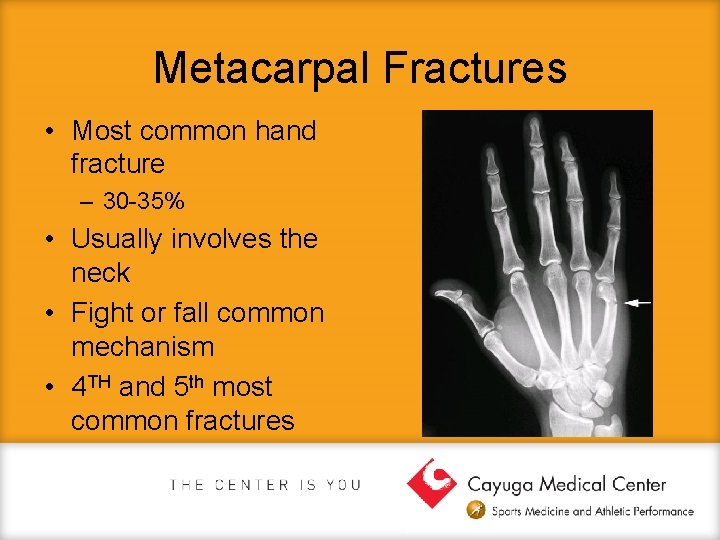 Metacarpal Fractures • Most common hand fracture – 30 -35% • Usually involves the